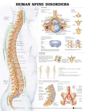 Anatomical Chart Company Anatomical Chart Human Spine Disorders 20 X 26 Inch Plastic Wall Mount Laminated – 9781587794438