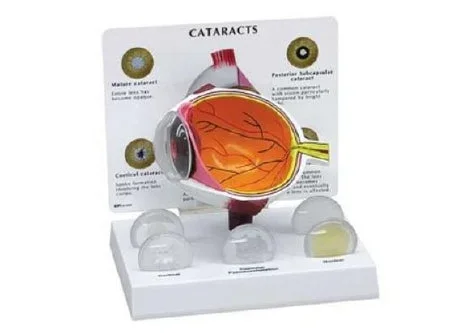 Anatomical Chart Company Cataract Eye Model – G280