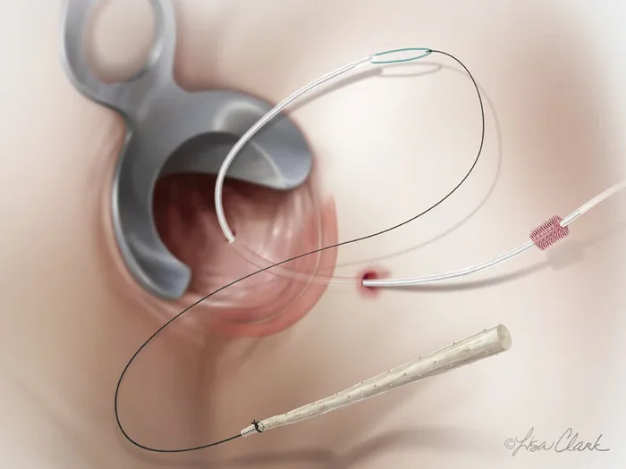 Cook Medical Biodesign Anal Fistula Plug Set – G53614