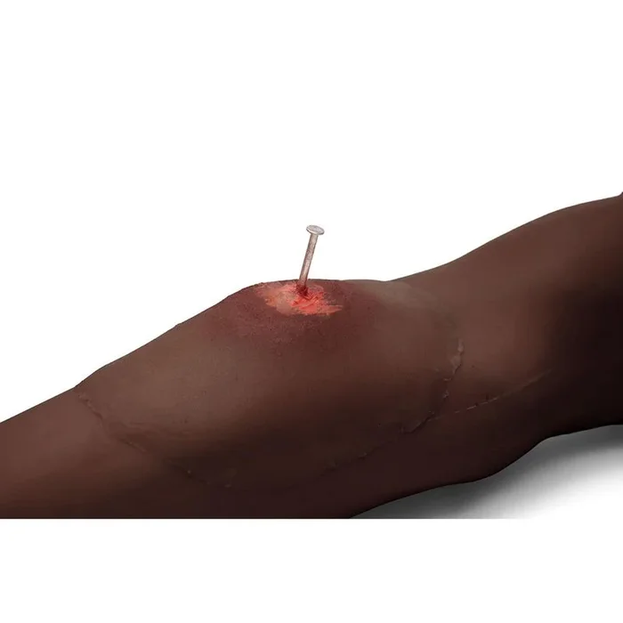 Sticky Wound Foreign Body: Nail